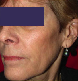 co2 skin resurfacing before and after results