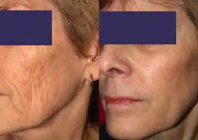 CO2 Skin Resurfacing before and after photo by La Bella Laser & Slimming Inc. in Arcadia, CA