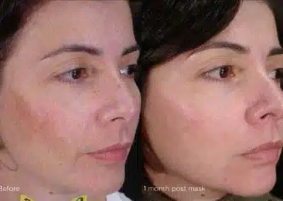 Cosmelan®MD Depigmentation Treatment before and after photo by La Bella Laser & Slimming Inc. in Arcadia, CA