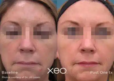 IPL Photo Facial before and after photo by La Bella Laser & Slimming Inc. in Arcadia, CA