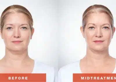 Kybella Fat Removal (For Double Chin) before and after photo by La Bella Laser & Slimming Inc. in Arcadia, CA