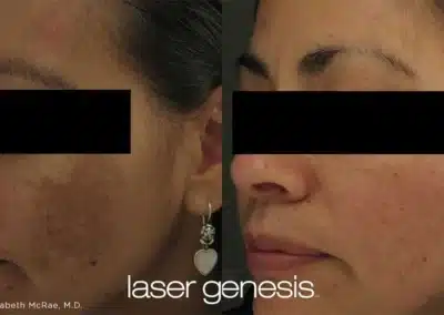 Laser Genesis before and after photo by La Bella Laser & Slimming Inc. in Arcadia, CA