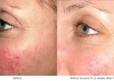 Laser Genesis before and after photo by La Bella Laser & Slimming Inc. in Arcadia, CA