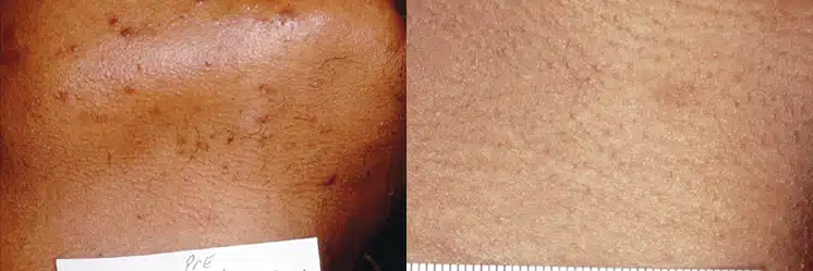 Laser Hair Removal before and after photo by La Bella Laser & Slimming Inc. in Arcadia, CA