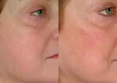 Laser Vein Removal before and after photo by La Bella Laser & Slimming Inc. in Arcadia, CA