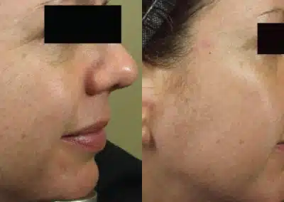 Micro Needling Skin Resurfacing before and after photo by La Bella Laser & Slimming Inc. in Arcadia, CA