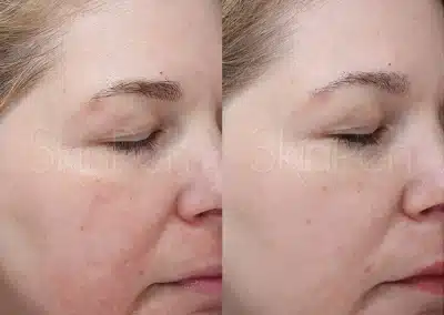 Micro Needling Skin Resurfacing before and after photo by La Bella Laser & Slimming Inc. in Arcadia, CA