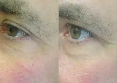 Micro Needling Skin Resurfacing before and after photo by La Bella Laser & Slimming Inc. in Arcadia, CA