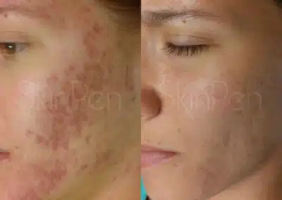 Micro Needling Skin Resurfacing before and after photo by La Bella Laser & Slimming Inc. in Arcadia, CA