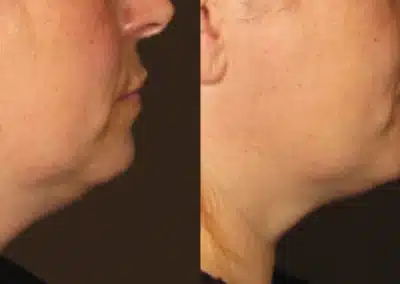 Ultherapy Non Invasive Face lift before and after photo by La Bella Laser & Slimming Inc. in Arcadia, CA