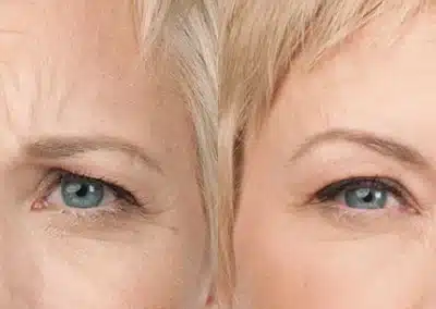 Botox before and after photo by La Bella Laser & Slimming Inc. in Arcadia, CA