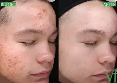 Chemical Peels before and after photo by La Bella Laser & Slimming Inc. in Arcadia, CA